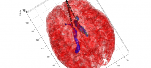 The brain (translucent, red) with the ventricles of the brain in blue. 