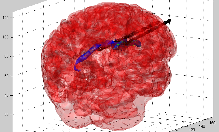 Brain + Ventricles + PCA 3